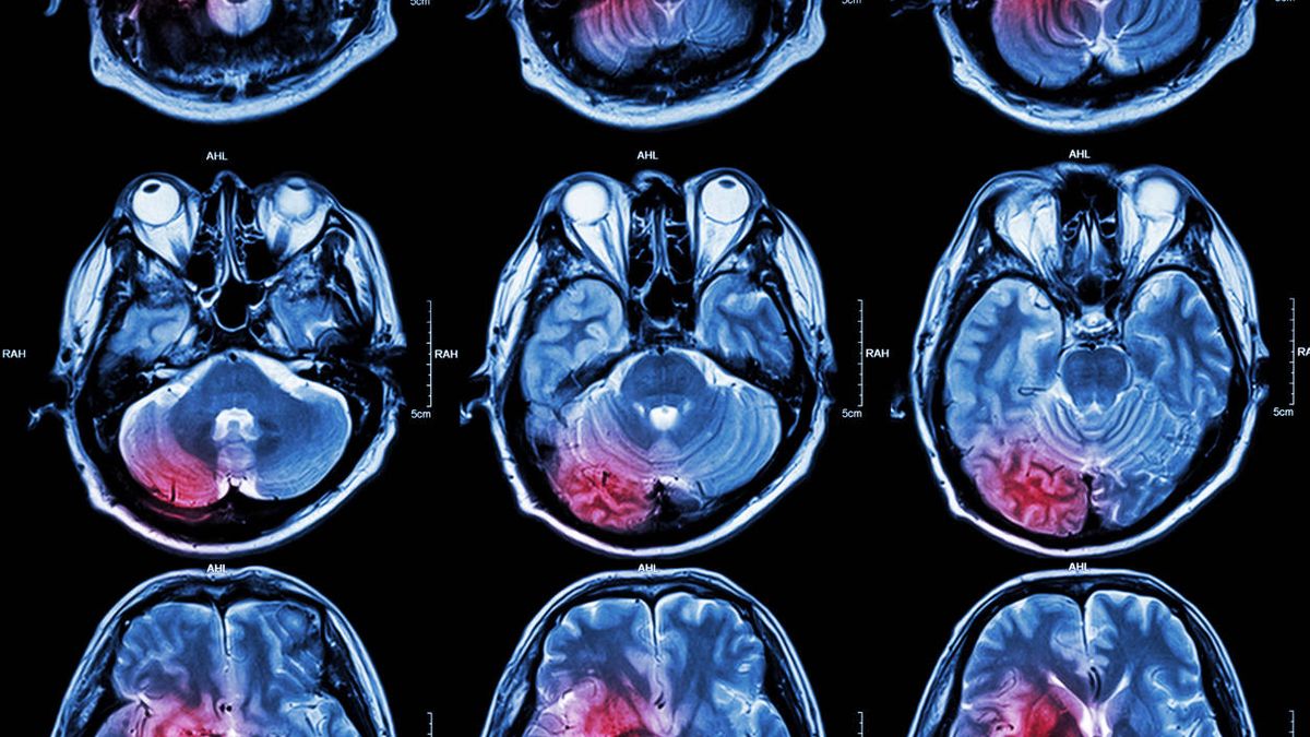 Descubren una enzima que podría ayudar a tratar un agresivo tumor cerebral